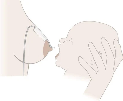Система для кормления Medela